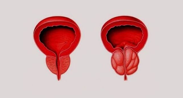 Zdrowa prostata (po lewej) i stan zapalny z powodu zapalenia gruczołu krokowego (po prawej)