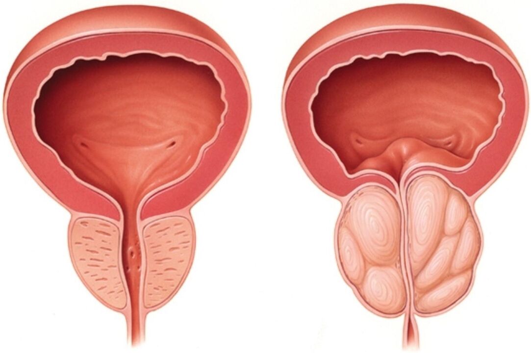 Prostata prawidłowa (po lewej) i z objawami zapalenia gruczołu krokowego (po prawej)