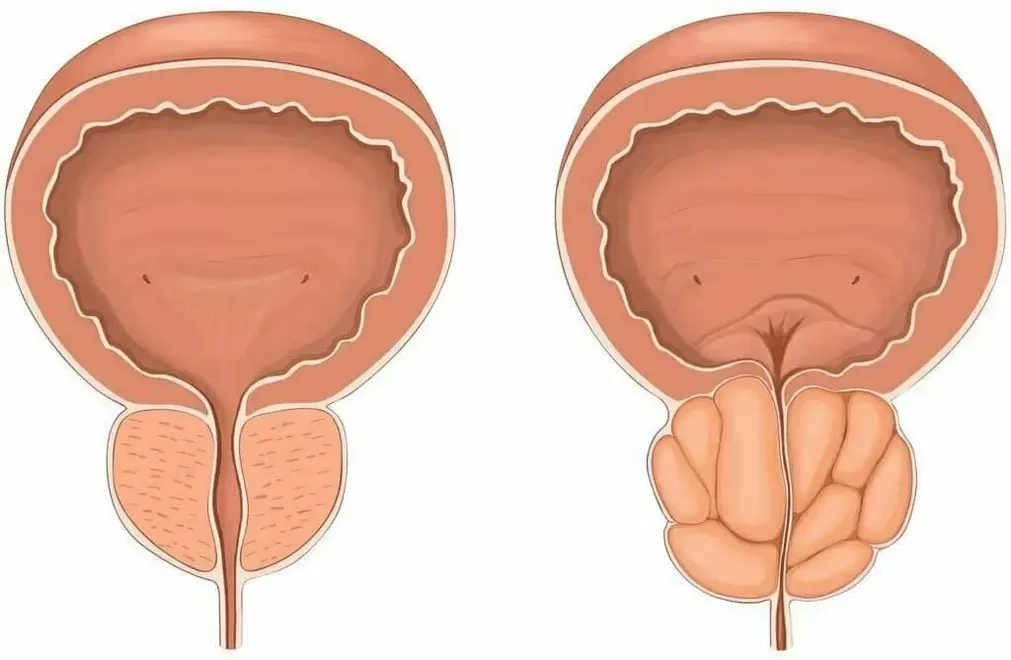 Normalna prostata i ból prostaty