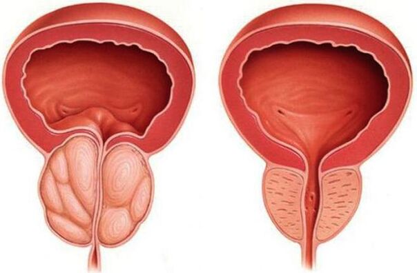 zdrowa i zapalona prostata z zapaleniem prostaty